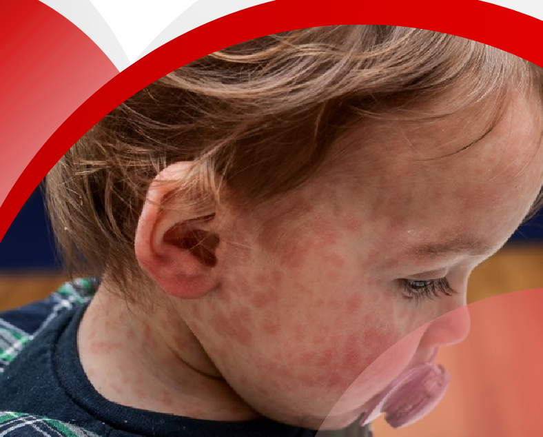 گزارش مراقبت تب و بثورات ماکولوپاپولار با تشریح وضعیت سرخک و سرخجه 